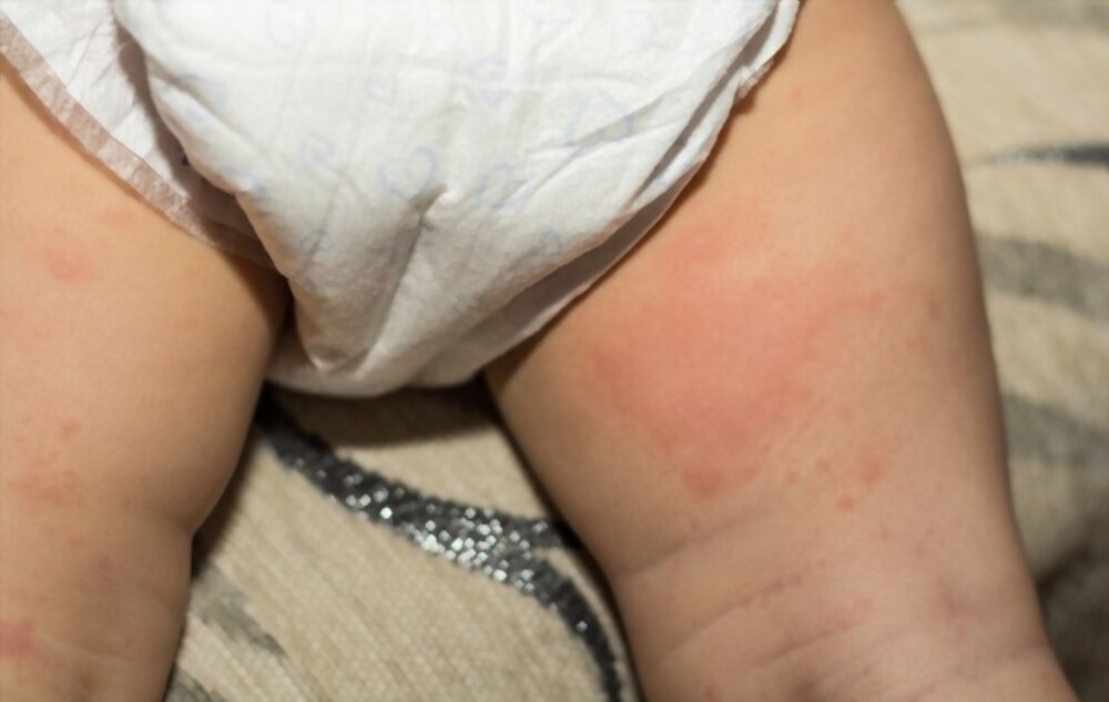 Natural Home Remedies for Diaper Rash in Babies